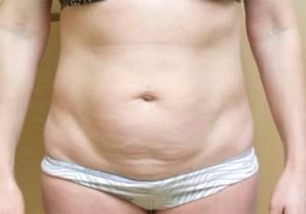 Before Image: Tummy Tuck - front