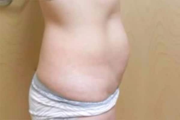 Before Image: Tummy Tuck - right-side