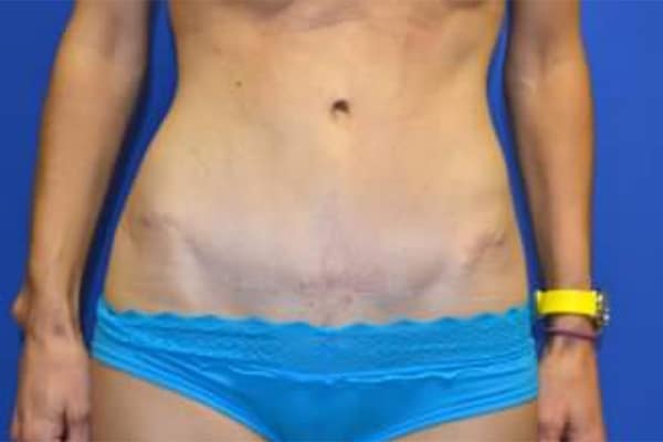 After Image: Tummy Tuck - front