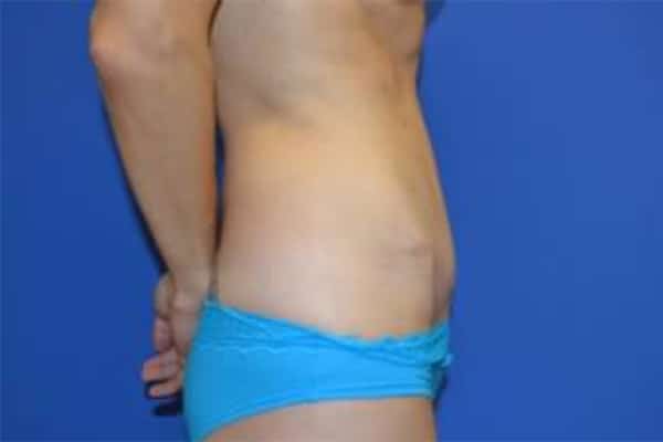 After Image: Tummy Tuck - right-side