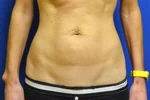Before Image: Tummy Tuck