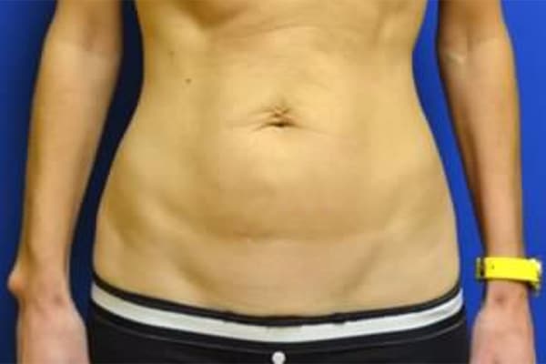 Before Image: Tummy Tuck - front