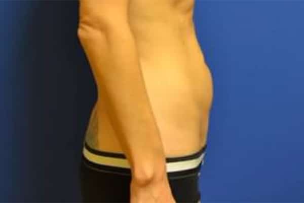 Before Image: Tummy Tuck - right-side