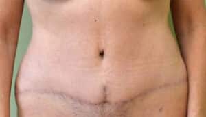 After Image: Tummy Tuck