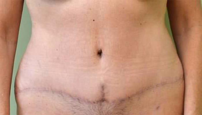After Image: Tummy Tuck - front