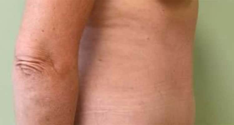 After Image: Tummy Tuck - right-side
