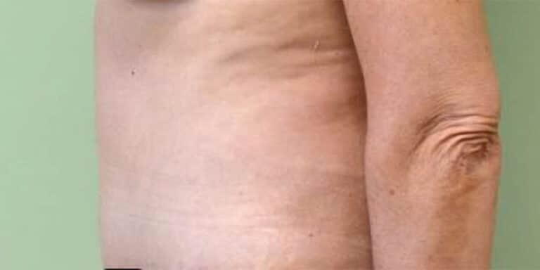 After Image: Tummy Tuck - left-side