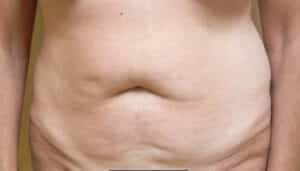 Before Image: Tummy Tuck