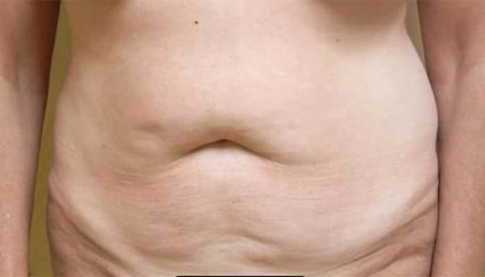 Before Image: Tummy Tuck - front