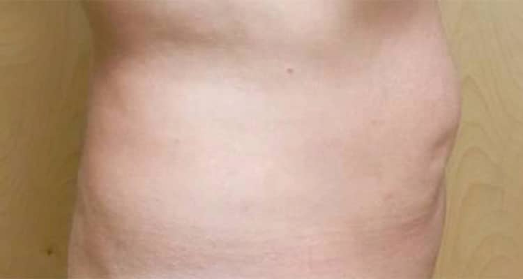 Before Image: Tummy Tuck - right-side