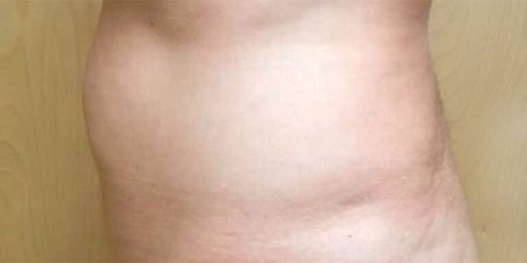 Before Image: Tummy Tuck - left-side