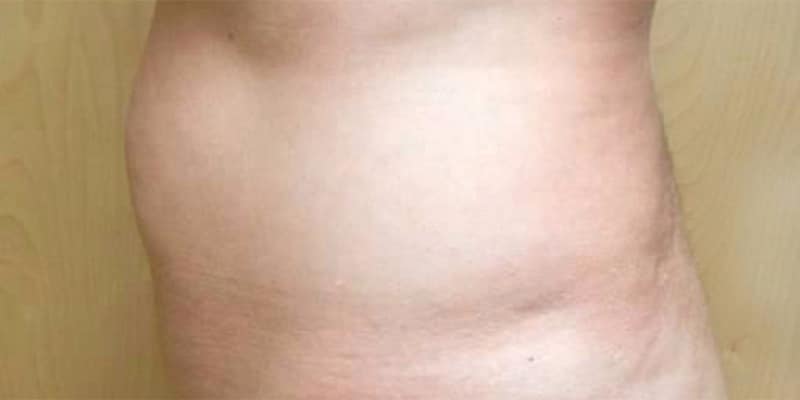 Before Image: Tummy Tuck - left-side