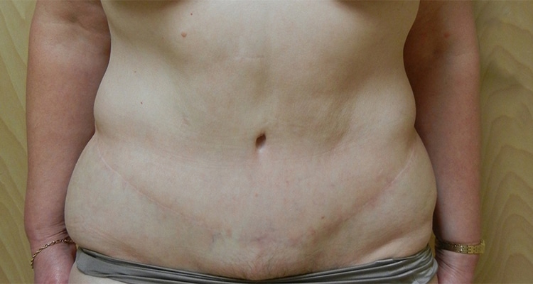 After Image: Tummy Tuck - front
