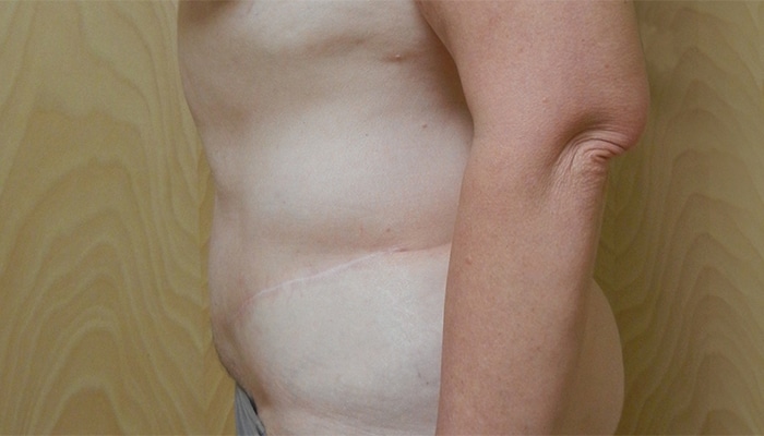 After Image: Tummy Tuck - left-side