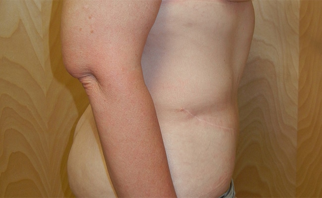 After Image: Tummy Tuck - right-side