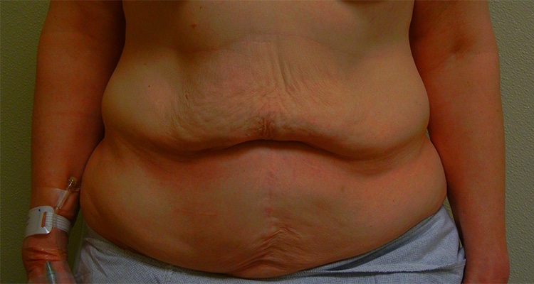 Before Image: Tummy Tuck - front