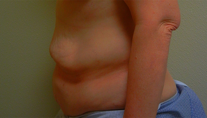 Before Image: Tummy Tuck - left-side