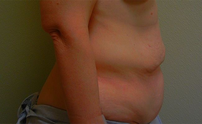 Before Image: Tummy Tuck - right-side