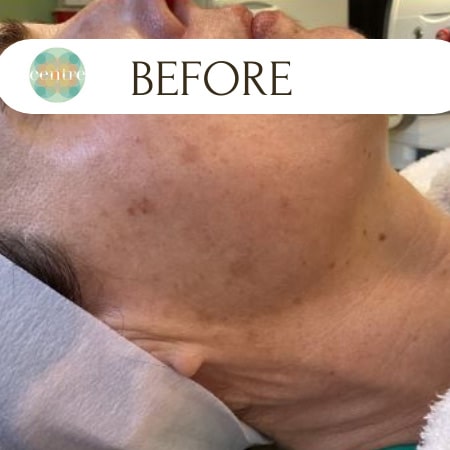 Before Image: IPL - front