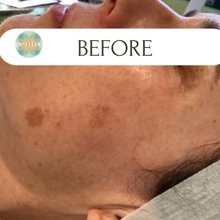 Before Image: IPL - front