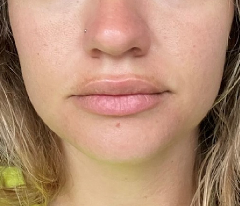 After Image: Lip Flip - front