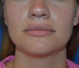Before Image: Lip Flip