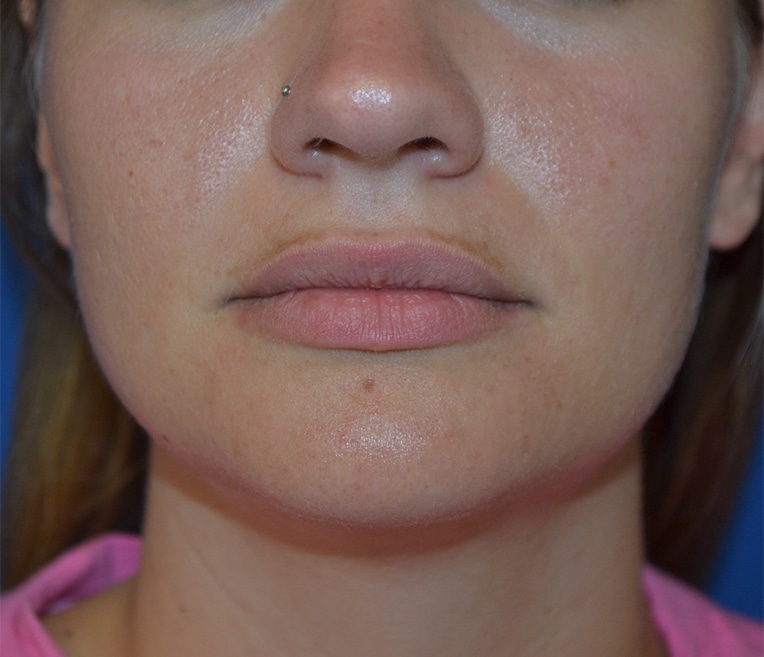 Before Image: Lip Flip - front
