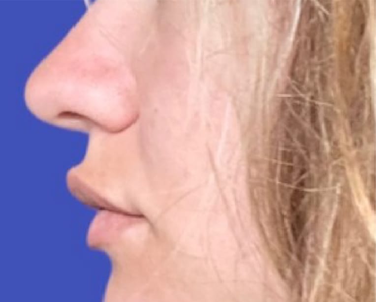 After Image: Lip Flip - left-side