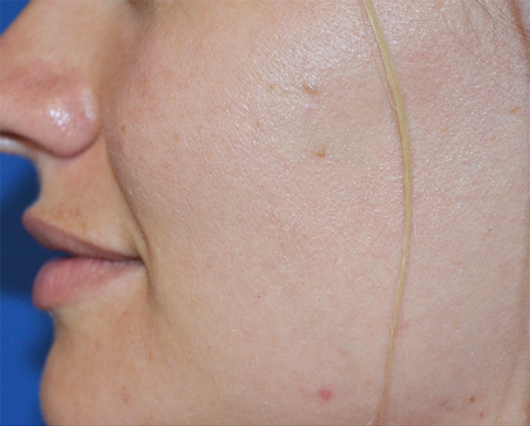 Before Image: Lip Flip - left-side