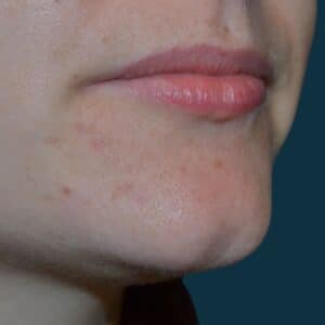 Before Image: Lip Filler