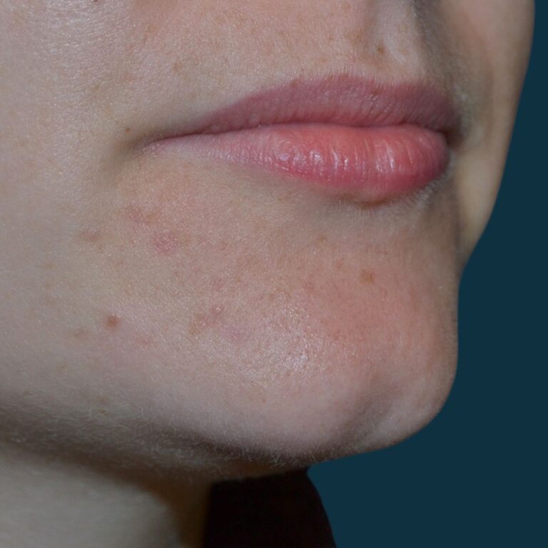Before Image: Lip Filler - right-front-oblique