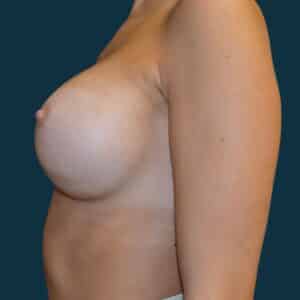 After Image: Breast Augmentation