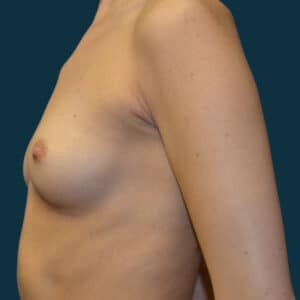 Before Image: Breast Augmentation