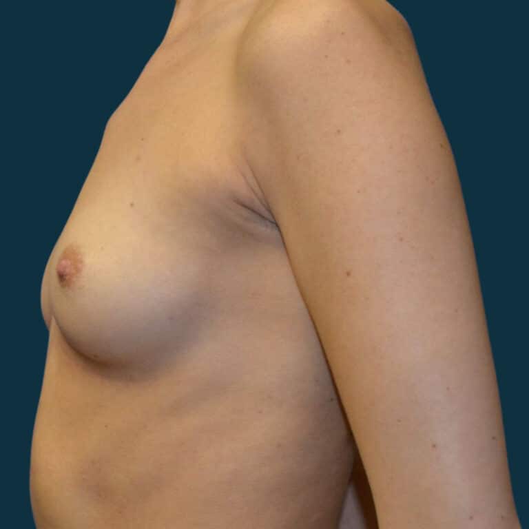 Before Image: Breast Augmentation - left-side