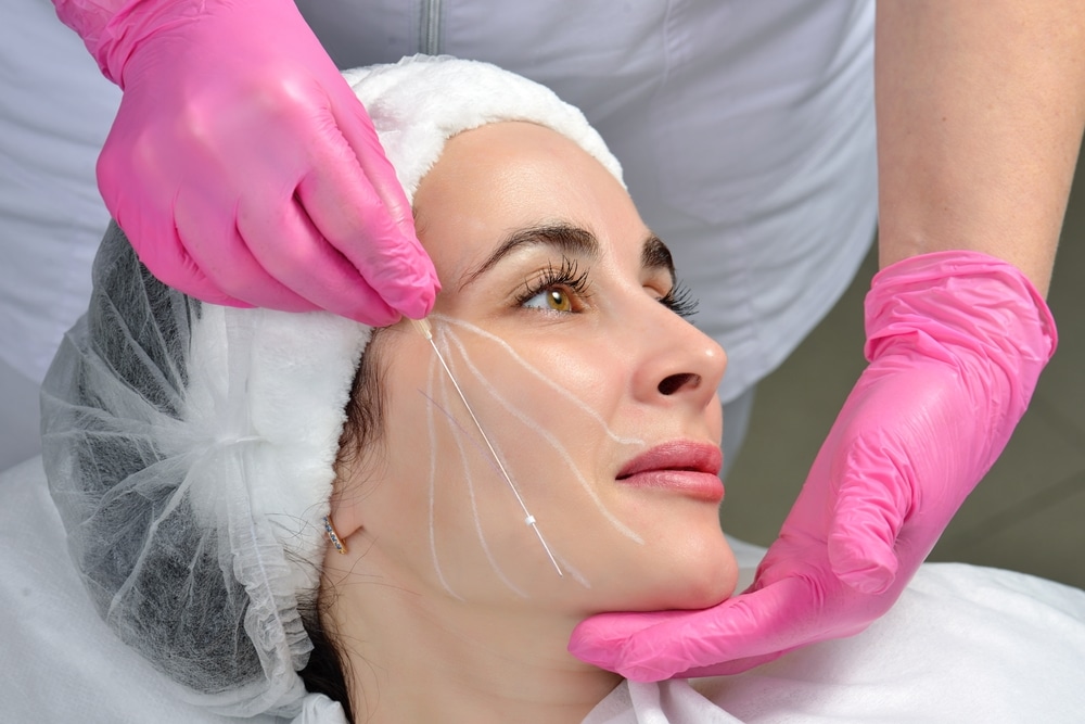 How Long Do PDO Thread Lift Results Last?