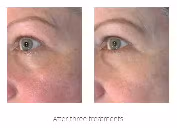 Before & After Image of Vivace Fractional Micro Needle RF East Greenwich RI