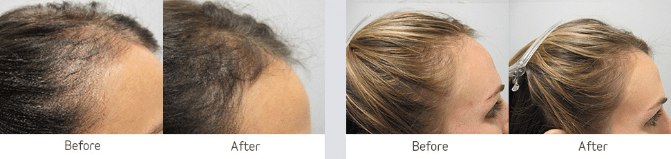 Before & After Image of Viviscal Professional East Greenwich RI