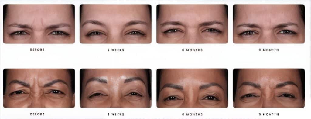 Frown Line Treatment East Greenwich RI